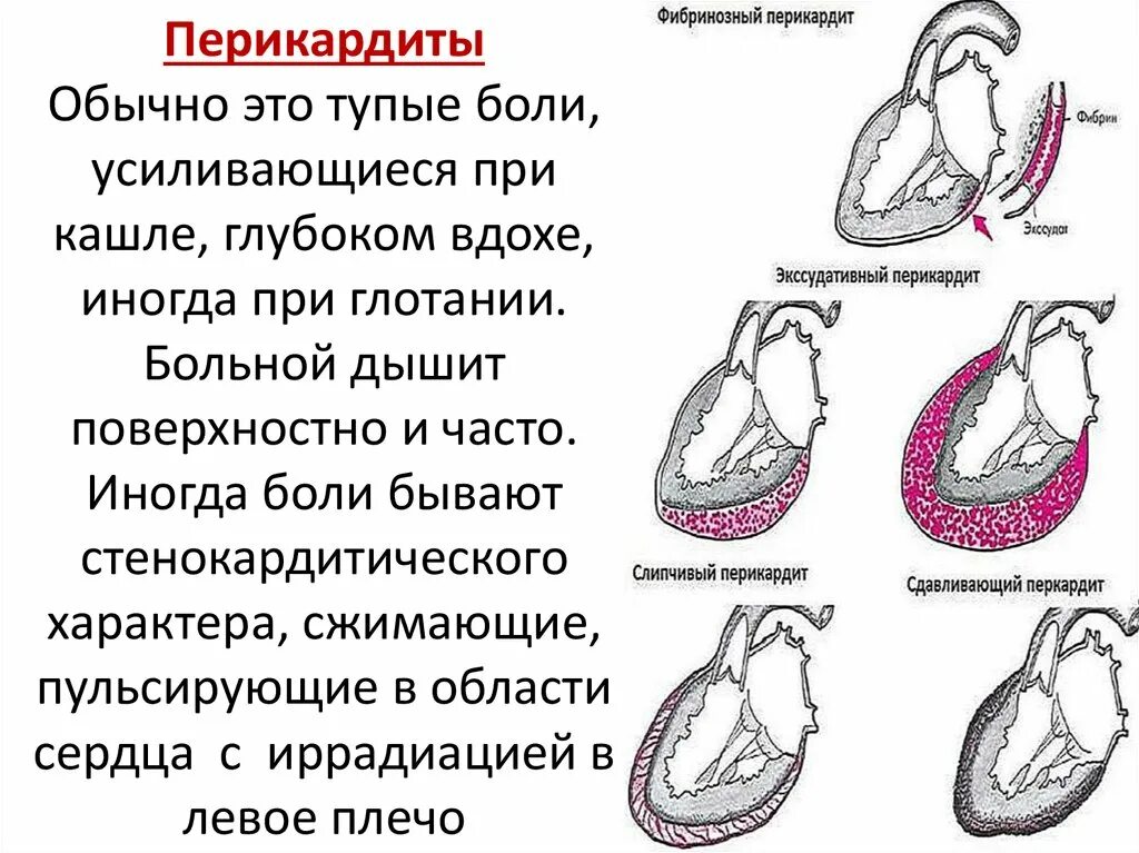 Болит сердце при вдохе и выдохе. Боль в области сердца при вдохе причины. Больно сердце при Глубоком вдохе. Колющая боль в области сердца при вдохе.