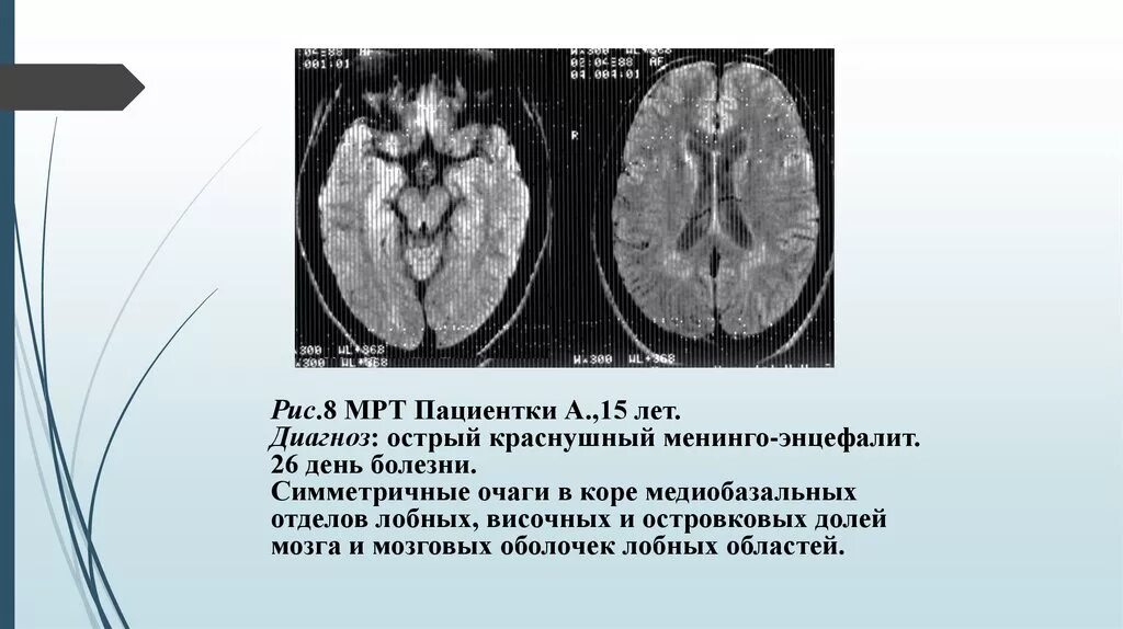 Симметричное заболевание. Подострый энцефалит мрт. Краснушного энцефалита. Височный энцефалит мрт. Коревой энцефалит клиника.