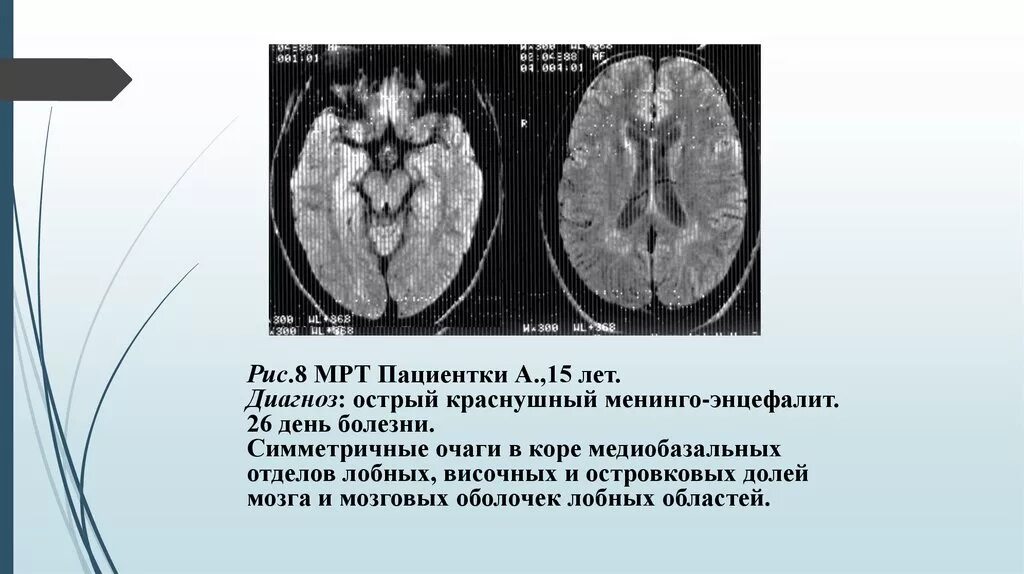 Герпетический энцефалит кт головного мозга. Краснушного энцефалита. Краснушный панэнцефалит. Энцефалит головного мозга у взрослых