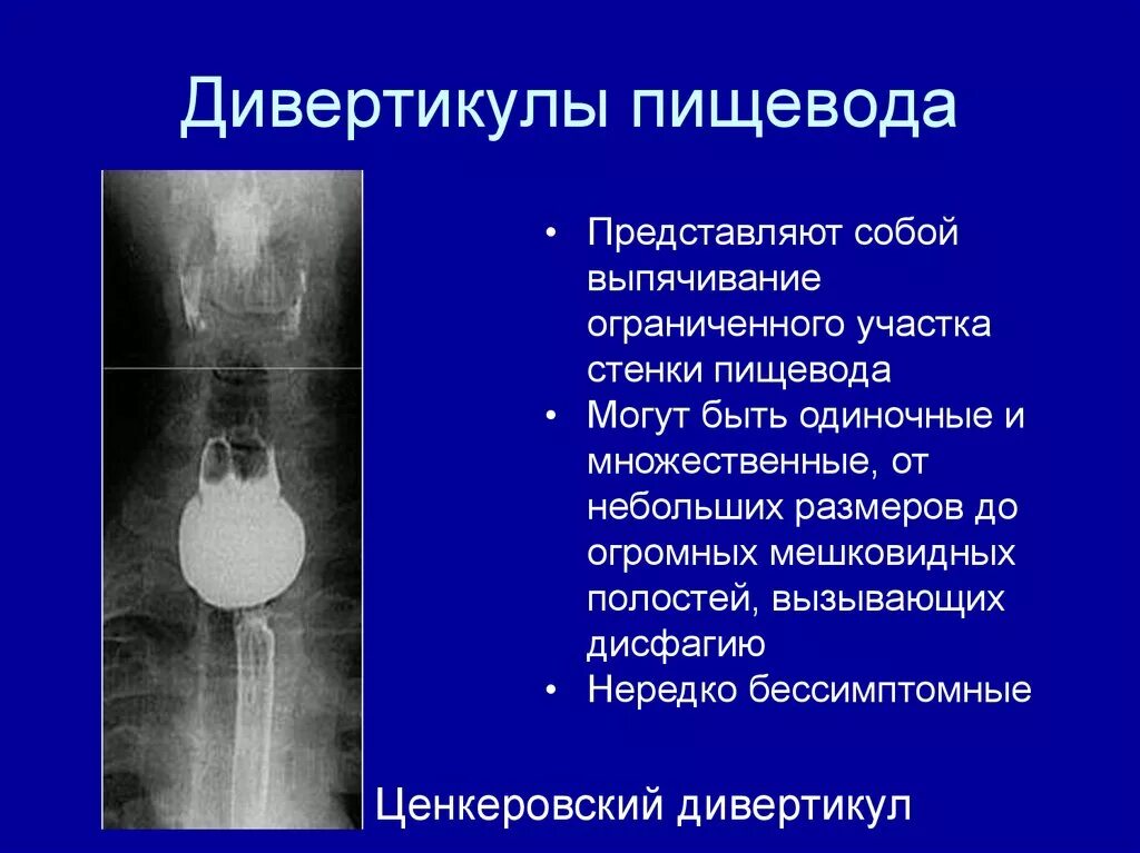 Дивертикулы пищевода классификация. Дивертикул пищевода рентген. Дивертикулы рентгенологическая картина. Дивертикул Ценкера пищевода.