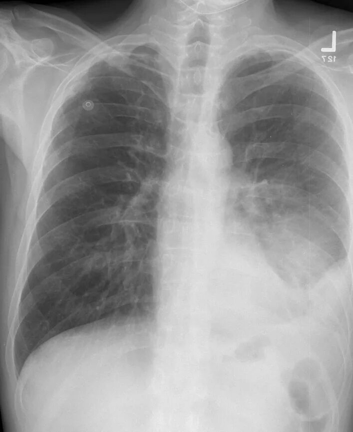 плевродиафрагмальные шварты. рентгенологические симптомы экссудативного плеврита. острый абсцесс легкого клиника.