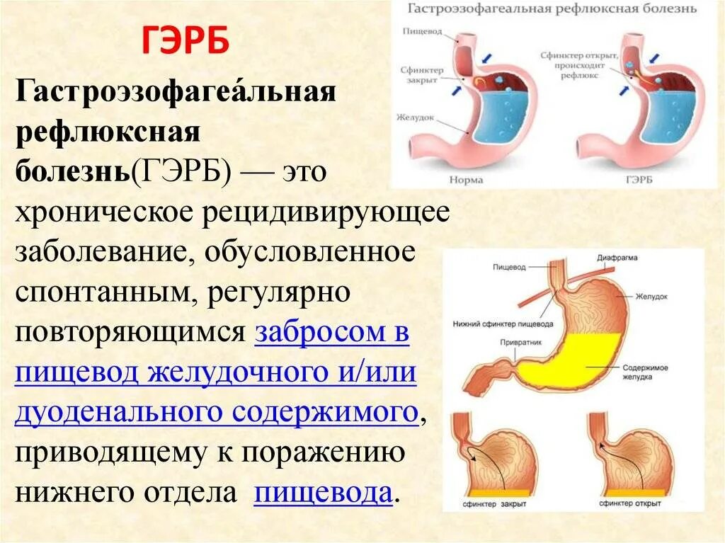 Пищевод открывается в желудок. Гастроэзофагеальная рефлюкс-болезнь. Гастроэзофагеальная рефлюксная Гастроэзофагеальная болезнь. Гастроэзофагеальной рефлюксной болезни. Газоэзофагальнаярефлюксная болезнь.