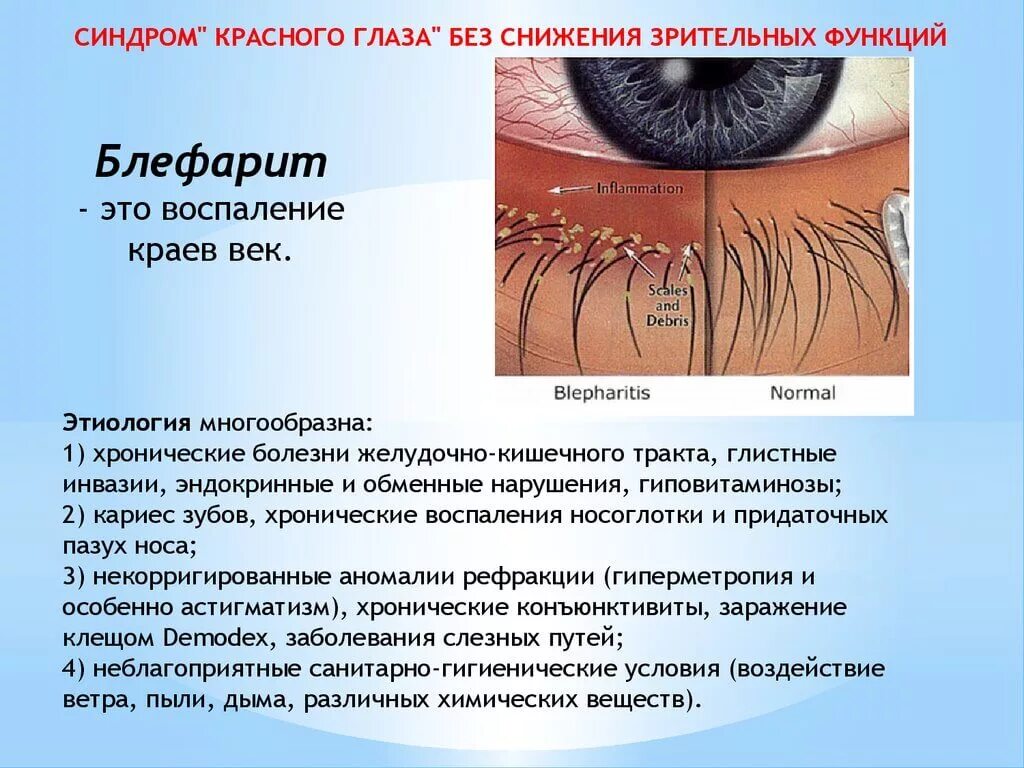 Гнойный синдром. Хронический себорейный блефарит. Блефарит — это воспаление век. Язвенный (стафилококковый) блефарит. Язвенный блефарит клиника.