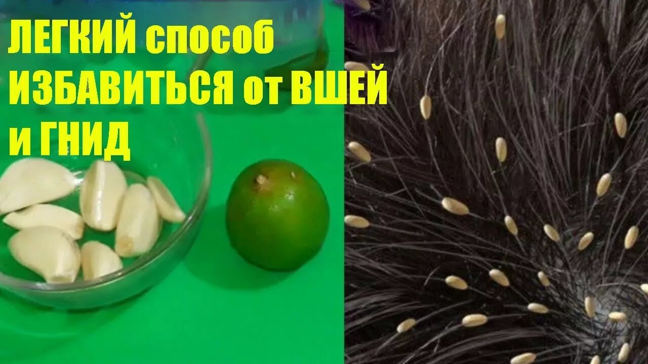 Как избавиться от вшей за день. Способы избавления от гнид. избавление от вшей на дому. народные средства от избавления вшей. народные средства от насекомых.