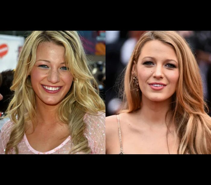 Блейк лайвли до операции. Блейк лайвли ринопластика. Блейк лайвли до и после операции. Блейк лайвли до пластики. Блейк лайвли до и после операции.