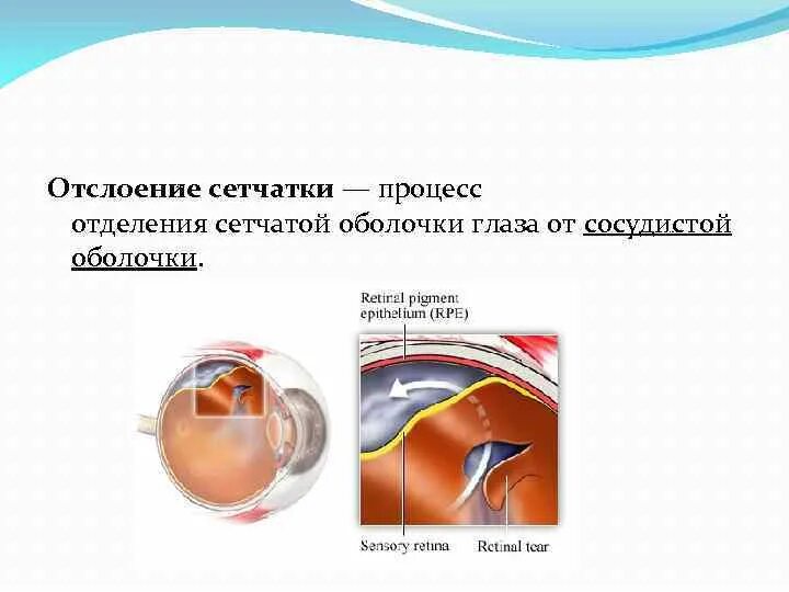 Первичная и вторичная отслойка сетчатки. Механические факторы отслойки сетчатки. Отслойка сетчатки глаза. Отслойка сетчатки глаза симптомы.