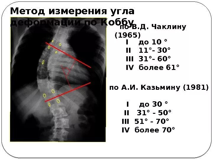 Сколиоз 3 степени угол Кобба. Измерение угла сколиоза по чаклину. Метод Кобба сколиоз степени. Степени сколиоза по чаклину рентген. Угол кобба