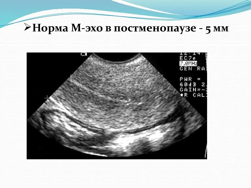 Эндометрия 13 мм. Эндометрия матки УЗИ гиперплазия эндометрия. М-Эхо 14 мм линейный. М Эхо в постменопаузе. М Эхо на УЗИ.