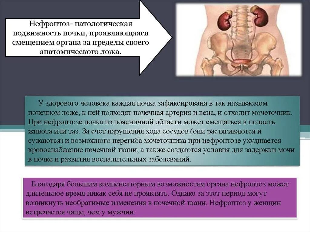 Левосторонний нефроптоз почки. Степени опущения почек. Боли при опущении почки