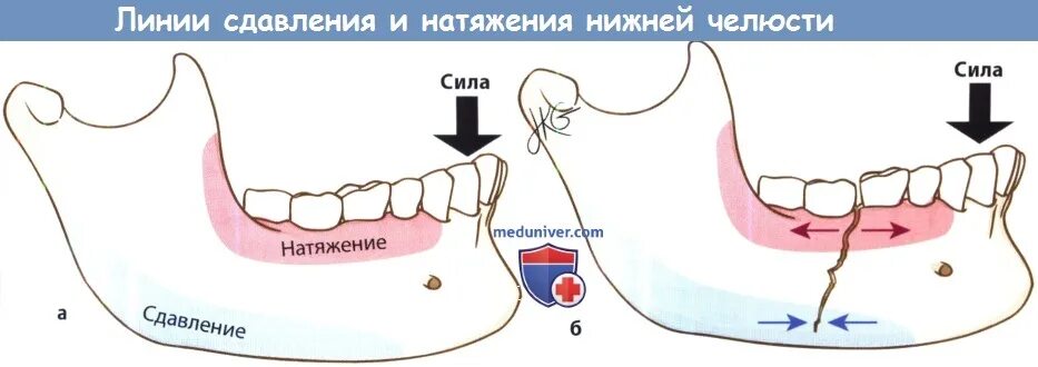 От чего может болеть челюсть. Дистальный сдвиг нижней челюсти. Скобы при травме челюсти. Сдавление челюсти причины.