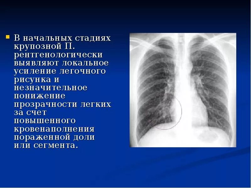 Усиленный в базальных отделах. Рентгенография ОГК пневмония. Крупозная пневмония рентген. Пневмония в стадии разрешения рентген. Крупозная пневмония рентген признаки.