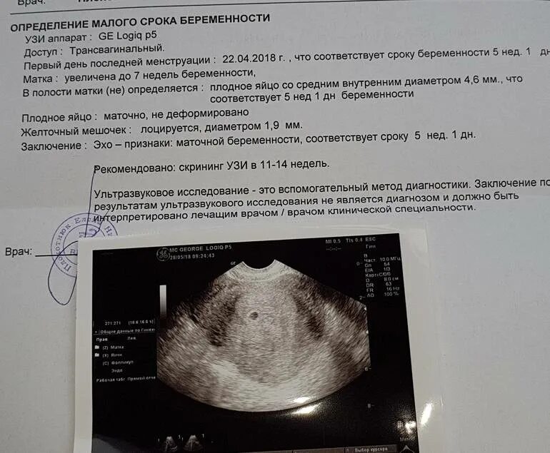 Может ли узи показать неправильно. Протокол узи беременности на ранних сроках. ультразвуковое исследование беременности малого срока. ультразвуковое исследование при беременности раннего срока. узи по беременности на ранних сроках.