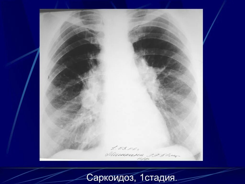 Саркоидоз 1. Саркоидоз 2 стадии рентген. саркоидоз классификация кт. саркоидоз лимфатических узлов. саркоидоз 1 стадия рентген.