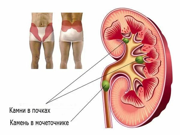 В мочеточнике соли. Камни в посках симптом. КАМНИТВ почках симптомы. Камни в почках симптомы у женщин симптомы.