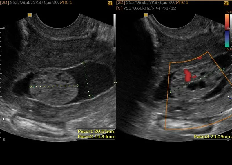 Рпкмшейки матки на УЗИ. На узи видно рак шейки