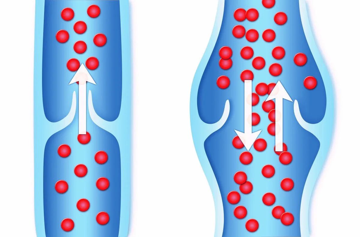 Венозные клапаны варикоз. Вертикальный рефлюкс крови. Вены ног клапаны