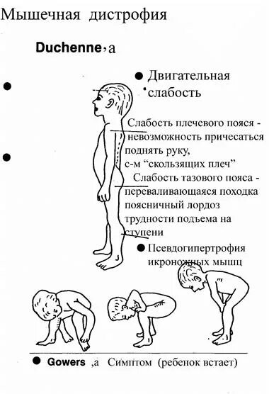 Синдром вялого ребенка. Псевдо гипертрофия икронодных мышц у ребенка. Псевдогипертрофия икроножных мышц у ребенка. Синдром вялого ребенка признаки.