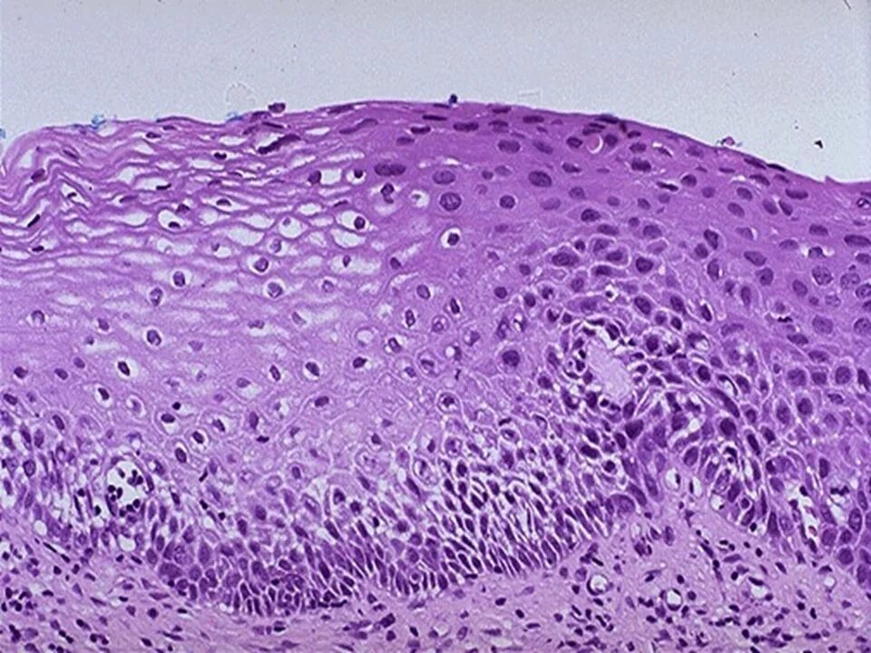 Клетки без признаков атипии. Дискератоз гистология. Дискератоз шейки матки гистология. Болезнь Боуэна гистология.