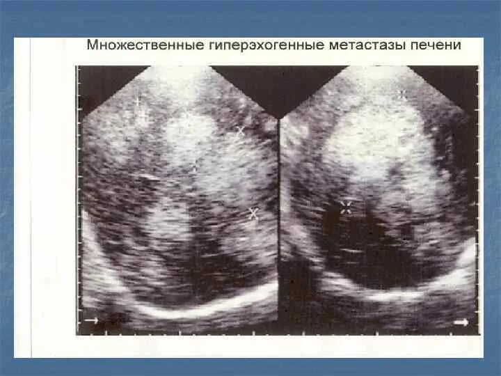 Множественные образования в печени. Гиперэхогенное образование в печени. Гиперэхогенная структура печени. Метастазы в печень гиперэхогенные УЗИ. Гиперэхогенные включения.