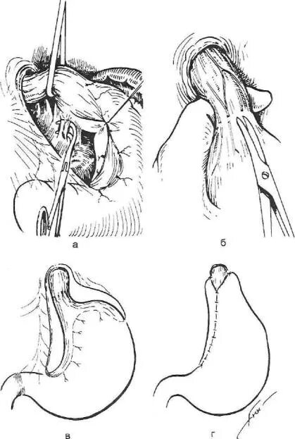Хирургическое лечение пищевода. Фундопликация рефлюкс. Рефлюкс эзофагит операция. Фундопликация пищевода.