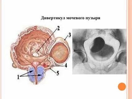 Операция мочевого дивертикул