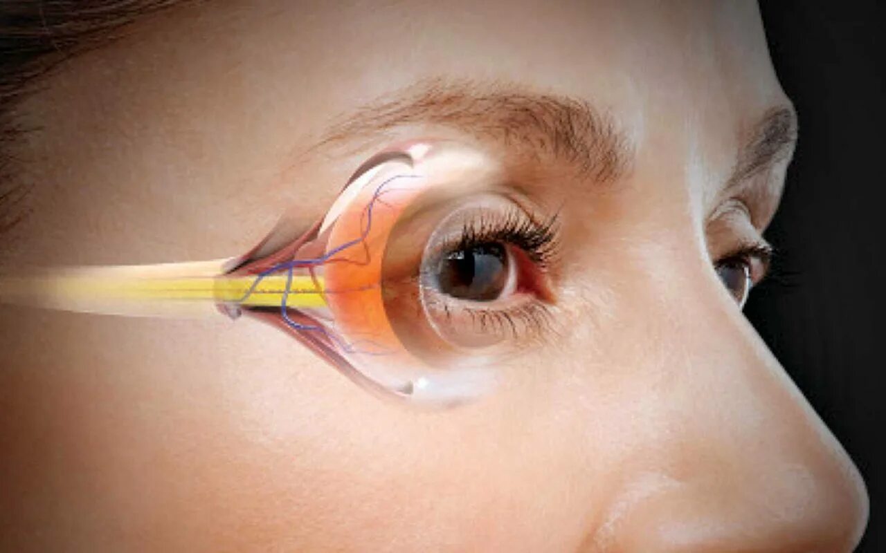 Глазное давление при катаракте. Глаукома внутриглазное. Глоэкома. Глколюкома.