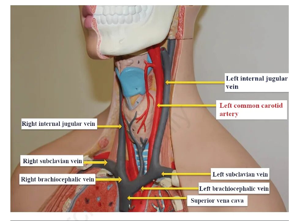 Internal jugular Vein на УЗИ. Catheterization of the Internal jugular Vein scheme. Internal access