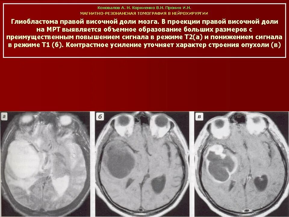 Глиобластома мультифокальный рост. ПЭТ-кт глиобластома. Глиобластома височной доли. После удаления глиобластомы