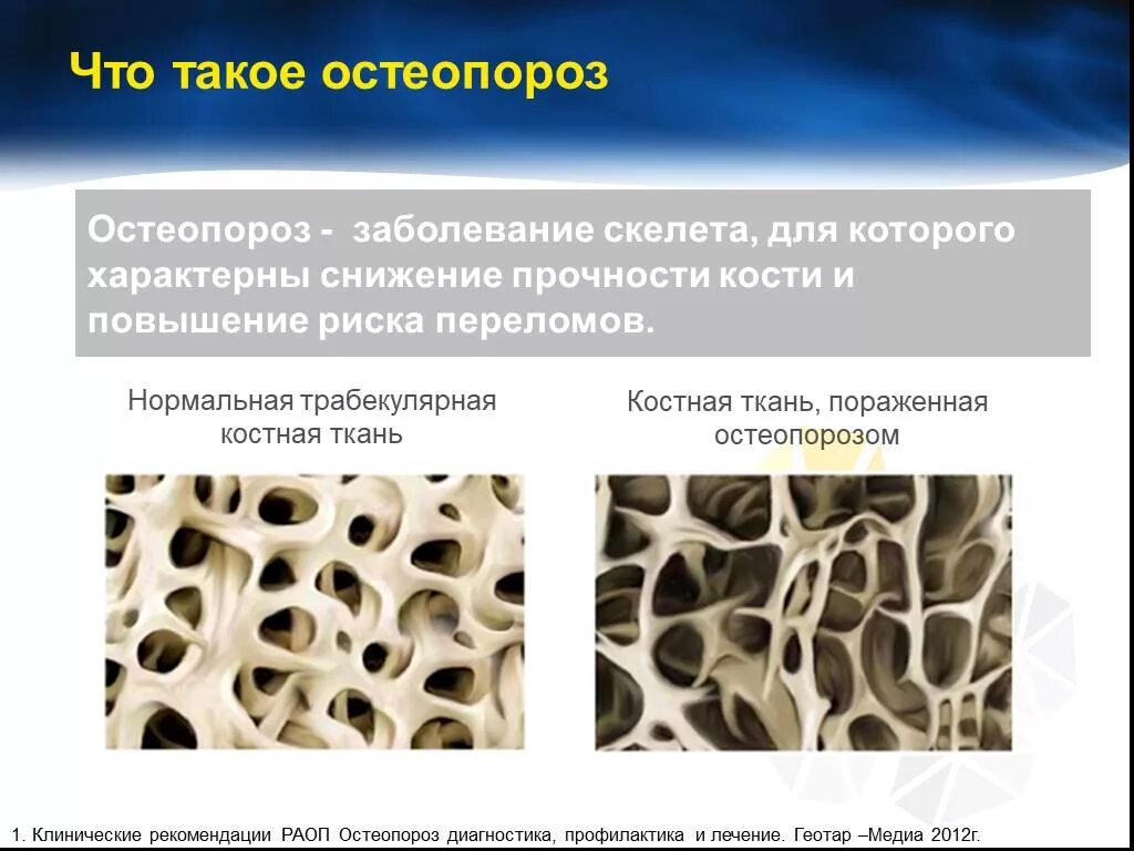 Трабекулярный остеопороз это. Костная ткань остеопороз. Трабекулярность костной ткани. Ячеисто трабекулярная перестройка костной ткани.