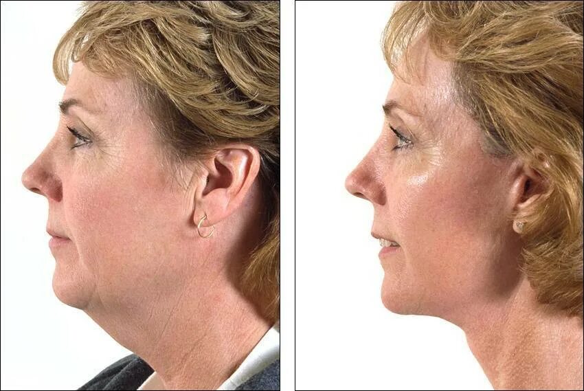 подтяжка второго подбородка. подтяжка второго подбородка. подтяжка шеи нитями аптос. безоперационная коррекция подбородка. смас лифтинг подбородка.