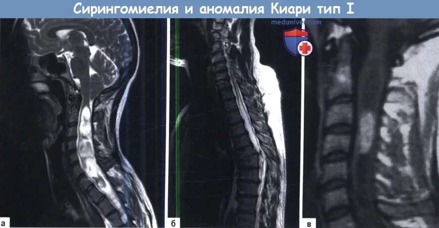 Киста в грудном отделе позвоночника. Сирингомиелия арнольда киари. сирингомиелия позвоночника мрт. сирингомиелия шейного отдела позвоночника мрт. гидромиелия шейного отдела спинного мозга.