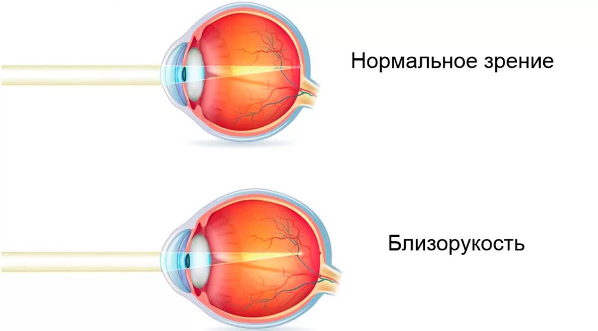 Зрения и дать решение. Миопия глазное яблоко. Форма глаза при близорукости. Глаз человека строение миопия. Неправильная форма глазного яблока при дальнозоркости.