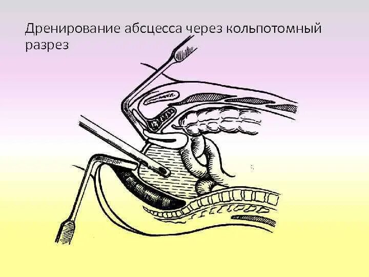 Дренаж при абсцессе. Дренирование абсцесса предстательной железы. вскрытие абсцесса флегмоны. дренаж аппендикулярного абсцесса. вскрытие и дренирование абсцесса.
