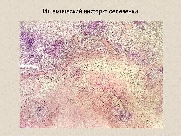 Геморрагический инфаркт легкого патанатомия макропрепарат. Геморрагический инфаркт легкого микропрепарат. Тромбоз сосудов легкого патанатомия. Геморрагический инфаркт легкого патанатомия. Геморрагический инфаркт легкого патанатомия.