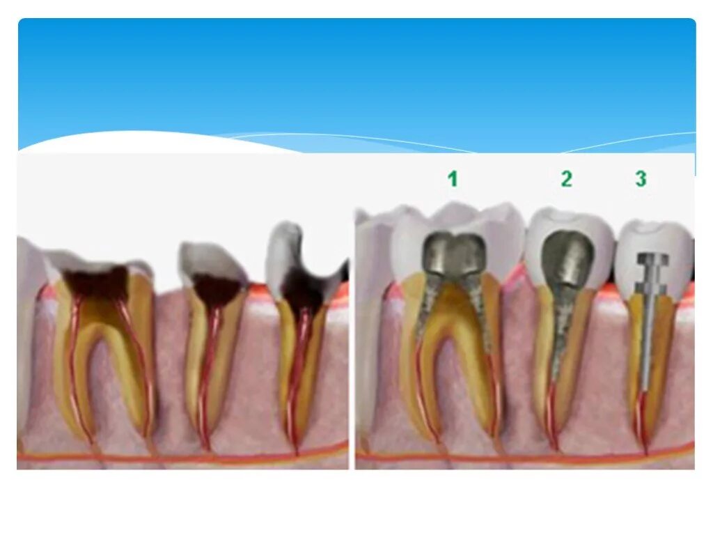 Почему открывают зуб. Культевая вкладка штифт зуб. Культевая вкладка 1 канальная. Внутрикорневая культевая вкладка. Штифитовао культеваявкладка.