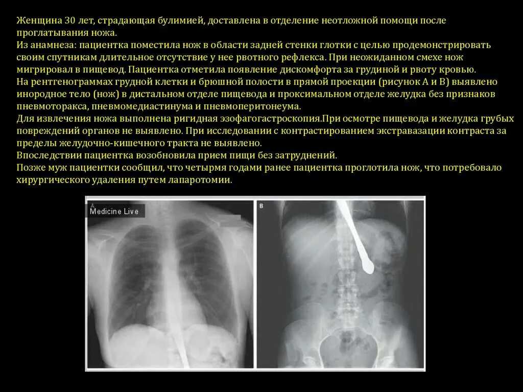 Инородное тело брюшной полости после операции. Перфорация полого органа в брюшной полости рентген. Рентгенограмма пневмоперитонеума. Инородные тела пищевода рентгенограммы. Рентгенологические признаки перфорации полого органа.