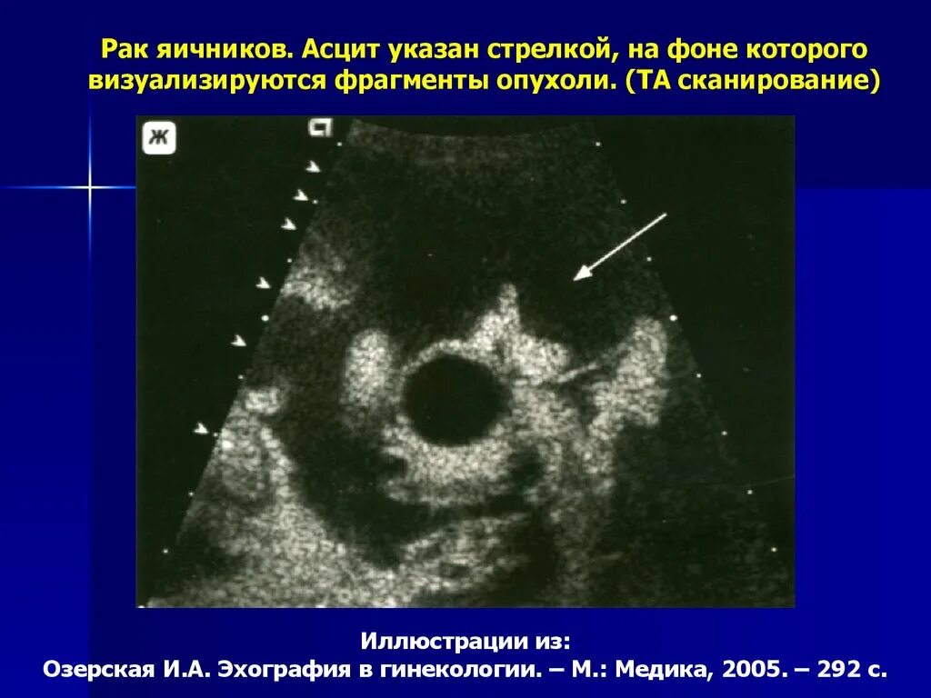 Объемное образование яичника УЗИ. Злокачественное новообразование яичника. Злокачественные новообразования яичников. Раковая опухоль яичника. Развитие рака яичников