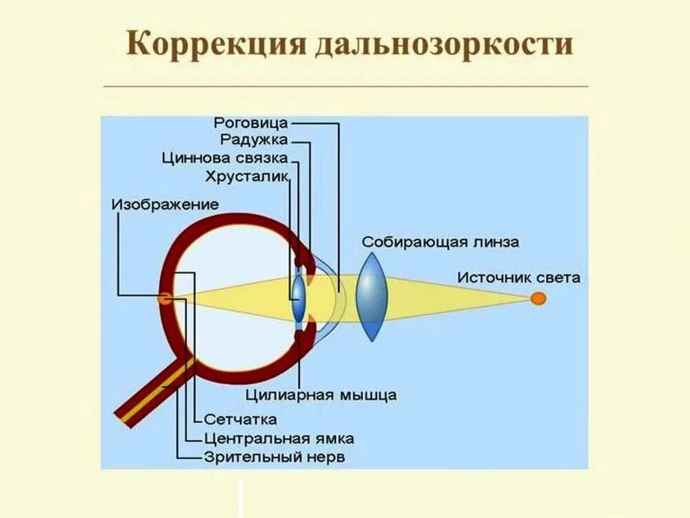 Операция при дальнозоркости. Коррекция дальнозоркости. Очковая коррекция гиперметропии. Методы коррекции гиперметрии. Методы коррекции пресбиопии.