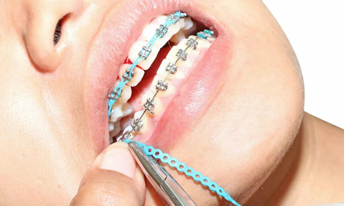 Ортодонтия что это. Эластические лигатуры ортодонтия. Резиновые лигатуры для брекетов. Эластические лигатуры для брекетов.