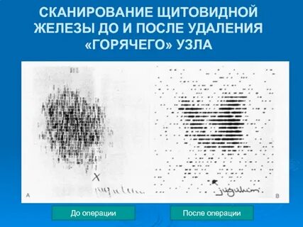 Стенография щитовидной железы