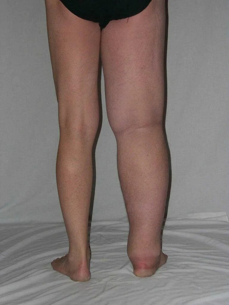 What kind of doctor treats edema?