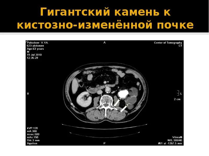 Плотность на кт. Конкремент в мочеточнике кт. конкремент правой почки кт. плотность конкрементов почек на кт.