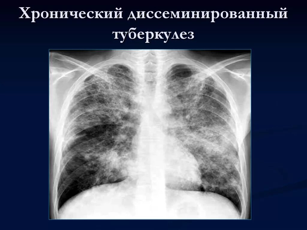 Острый диссеминированный туберкулез рентген. Хронический диссеминированный туберкулез легких рентген. Острый гематогенно-диссеминированный туберкулез рентген. Острый милиарный диссеминированный туберкулез.