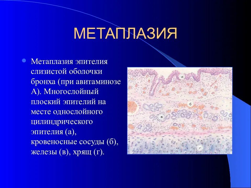 Метаплазия многослойного плоского эпителия микропрепарат. Метаплазированный эпителий гистология. Метаплазия эпителия слизистой оболочки бронха. Сквамозная метаплазия эпителия. Группы клеток метаплазированного