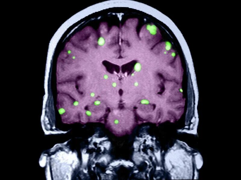 Лечение метастазов мозга. Метастатические опухоли головного мозга. ПЭТ кт метастазы в головной мозг. Метастазы меланомы в головной мозг кт.