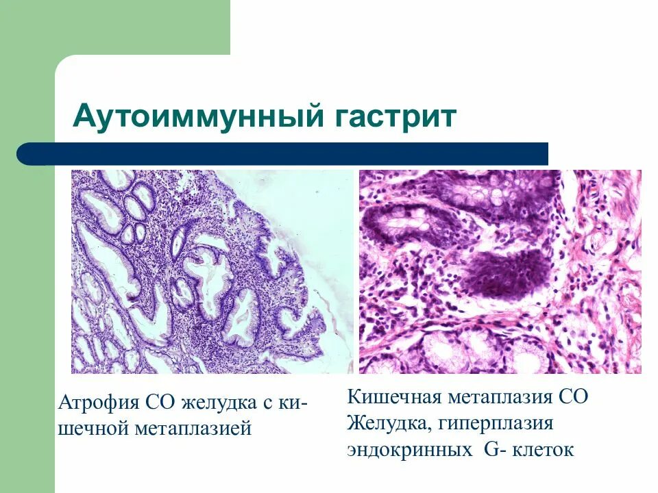 Метаплазия желудка отзывы. Метаплазия слизистой оболочки. Метаплазия желудка гистология. Метапластический гастрит гистология. Желудок хронический гастрит гистология.