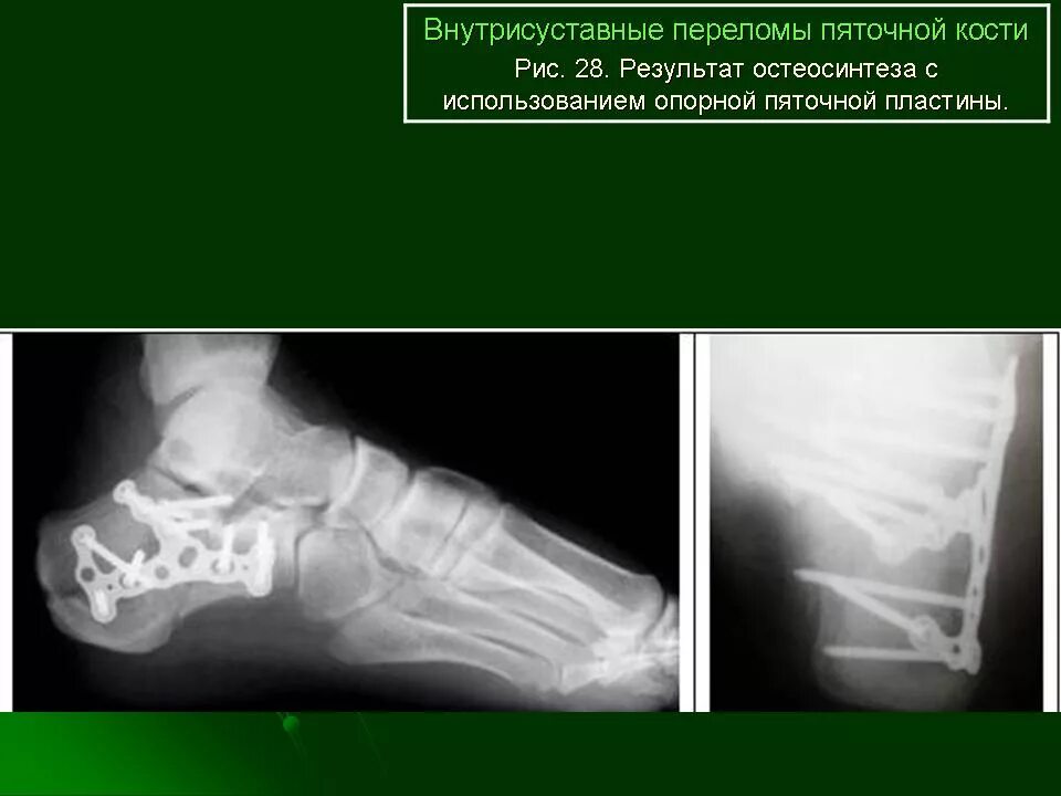 Операция пяточной кости. Перелом кубовидной кости. Компрессионный перелом пяточной кости рентген. Краевой внутрисуставной перелом. Операция остеосинтез пяточной кости.