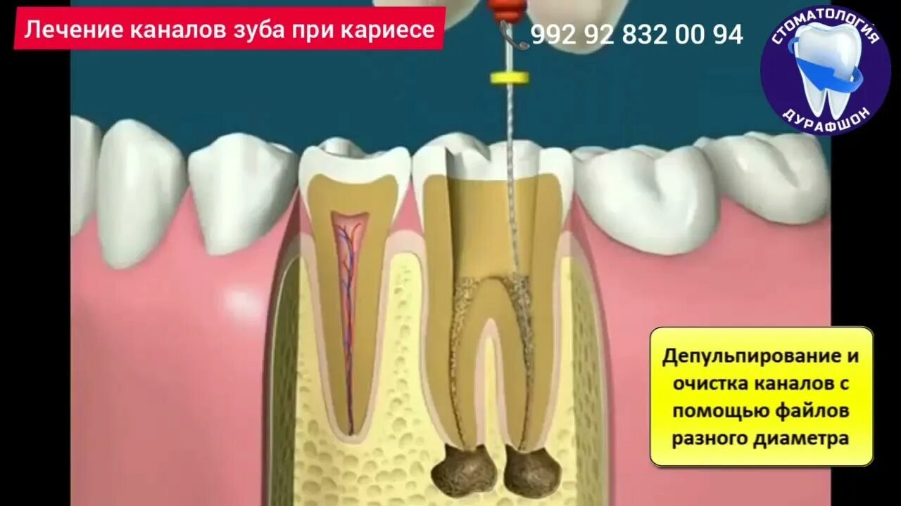 При каком кариесе удаляют зуб. Кариес под пломбой зуба.
