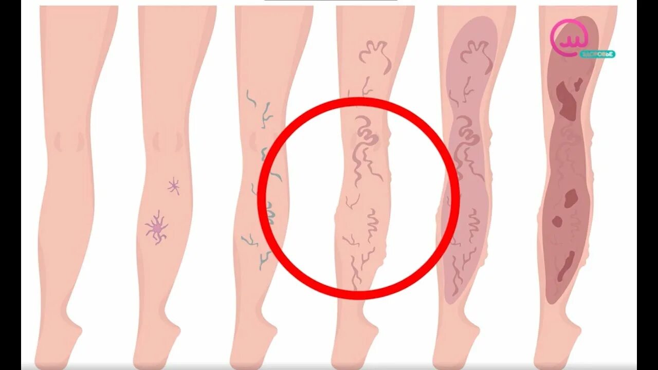 Вены до и после операции 2022 Arfurla Medical Radial Ptica Fiber 1470 Evlt Laser Surgery Fibras Ticas Las