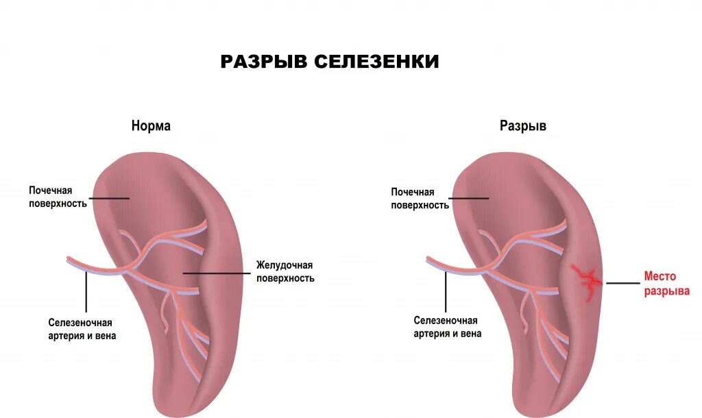 Селезенка может болеть. Болезненность селезенки. Селезёнка болит симптомы.